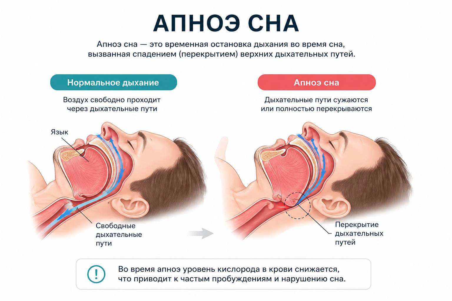 Храп и апноэ