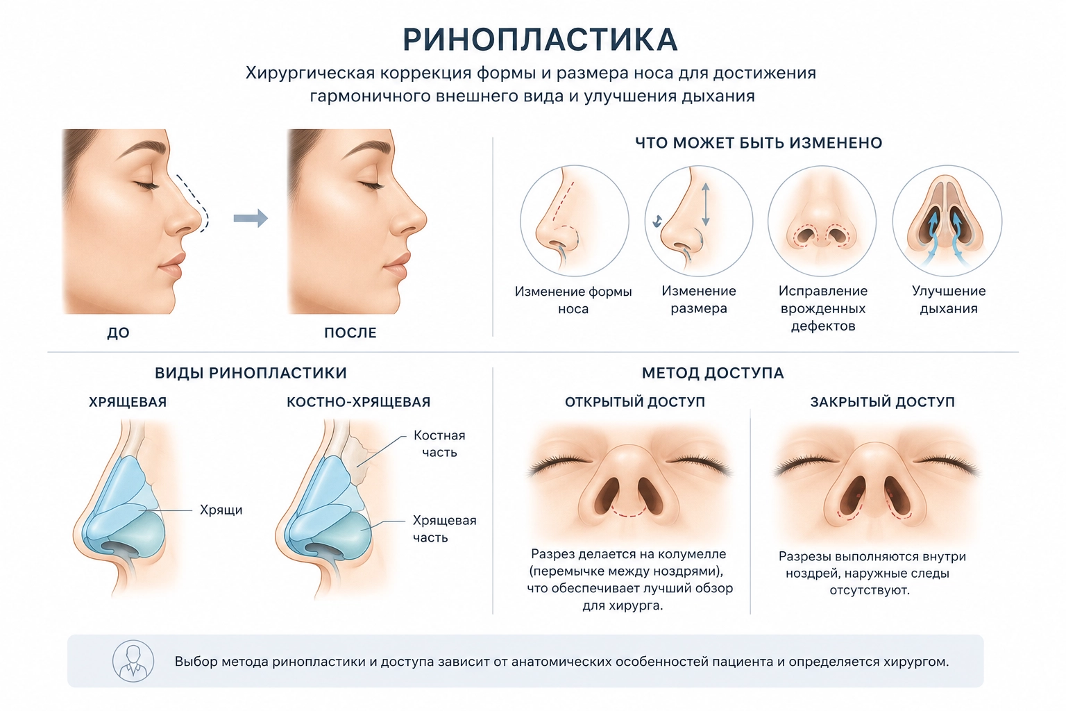 Схема ринопластики